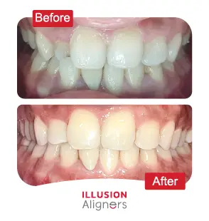 Illusion Aligners